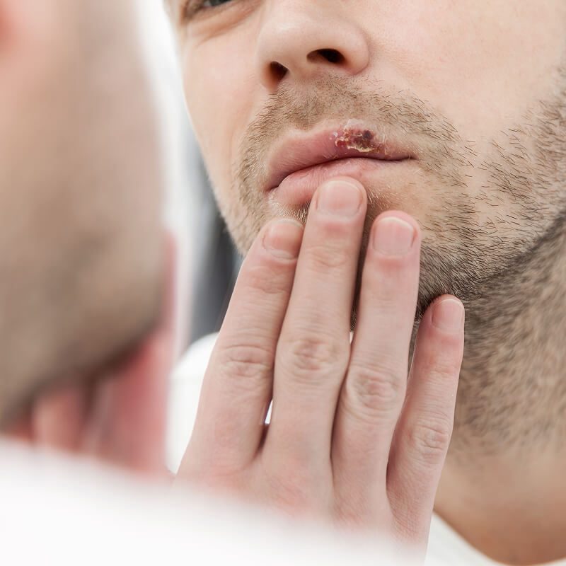 young-man-suffering-from-herpes-on-his-mouth-2024-09-18-19-10-46-utc